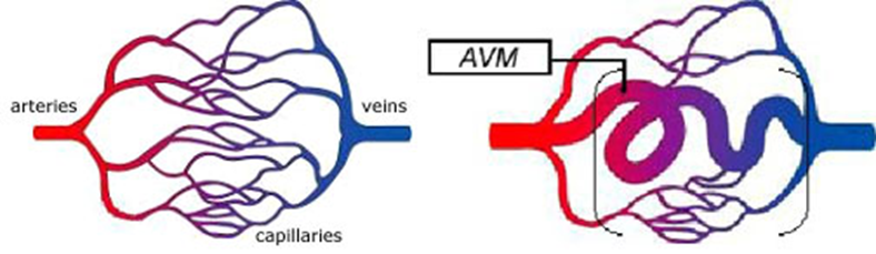 AVM heart arteries
