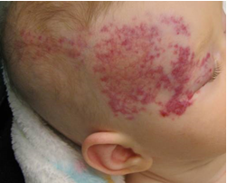 Example of a hemangioma that may be seen in infants with PHACE syndrome