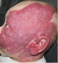 Example of a hemangioma that may be seen in infants with PHACE syndrome
