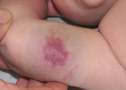congenital hemangiomas bruise on a child showing the congenital hemangiomas condition within birthmarks and vascular anomalies