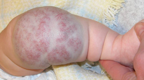 congenital hemangiomas knee on infant child