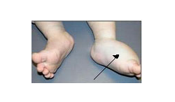 deep malformation