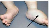 deep malformation