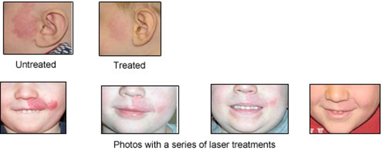 laser treatment photos