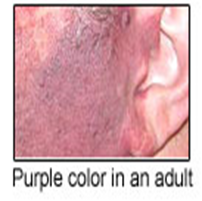 purple capillary malformation