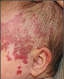 segmental hemangioma