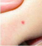 skin lesion wrist