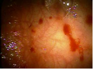 skin lesions in the stomach