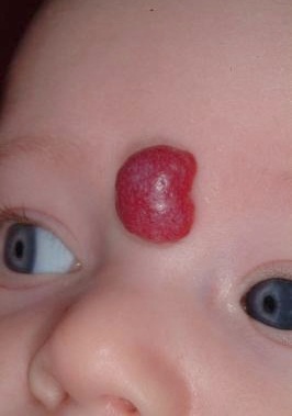 superficial hemangioma