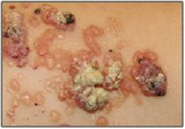 superficial malformation