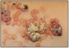 superficial malformation