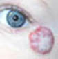 shrinking infanile hemangiomas