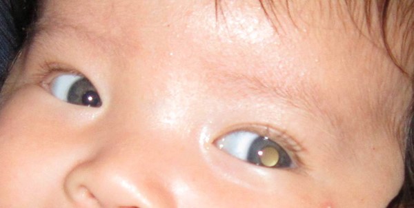 Retinoblastoma