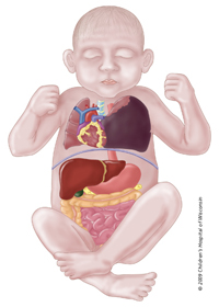 Large Micro or Macrocystic or a combination of the two lesions may cause other organs in the chest to shift.