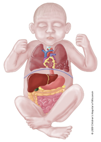 Macrocystic, which occurs in 50 percent of CPAM cases.