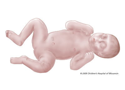 GastroschisisAftCR