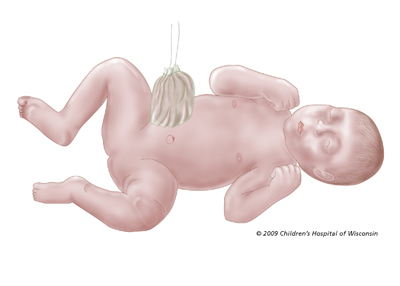 GastroschisisMidCR