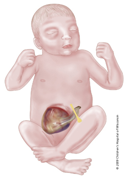 Omphalocele