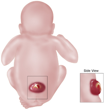 Spina bifida
