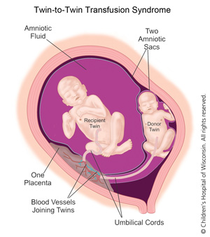 Twin-to-twin transfusion syndrome