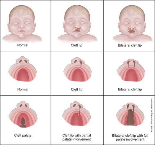 cleft525CR