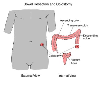 Bowel diagram
