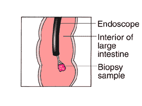 Colonoscopy