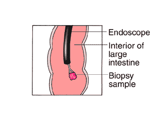 Colonoscopy