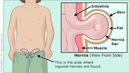 Inguinal Hernias