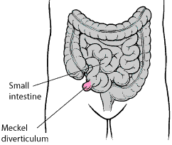 Meckel's diverticulum