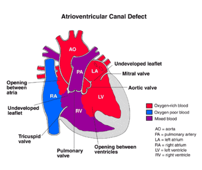 Illustration showing Atrioventricular Canal Defect.