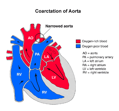 Anatomy of heart with coarctation of aorta.