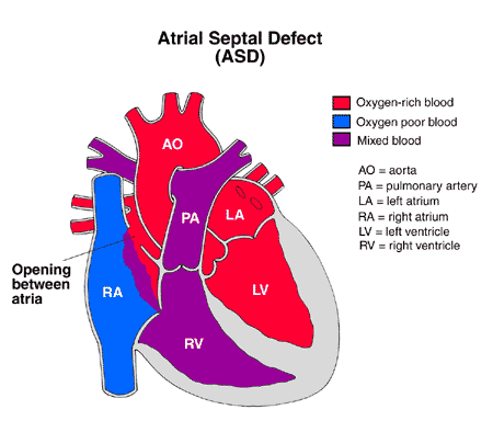 Heart with Atrial Septal Defect