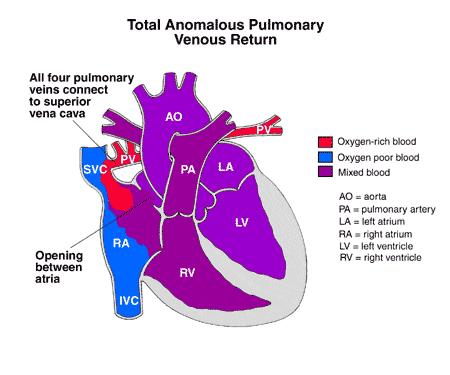 Total anomalous pulmonary venous return 