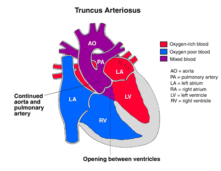 Diagram of a heart with truncus arteriosus heart condition.