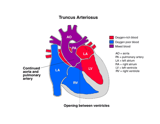 Diagram of a heart with truncus arteriosus heart condition.