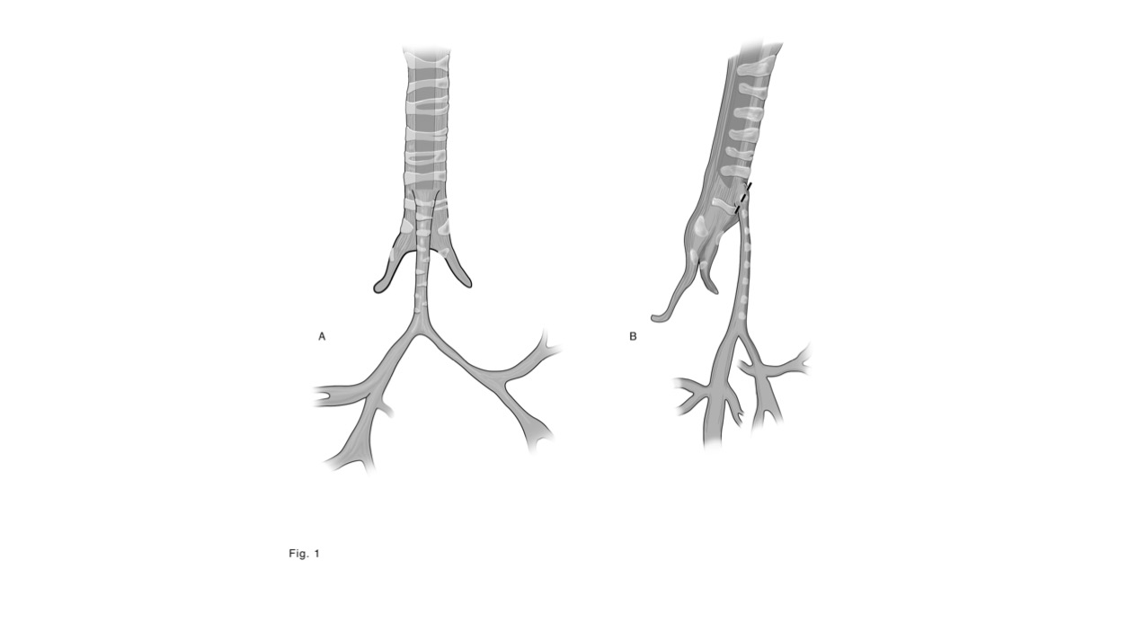 Tracheas before reconstruction