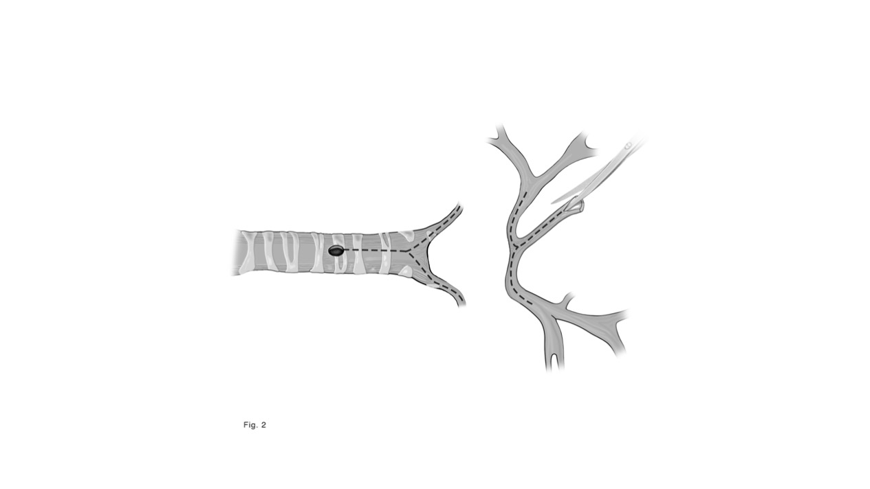 Step 1 of tracheal unifocalization, a procedure to bring the anterior and posterior tracheas together.