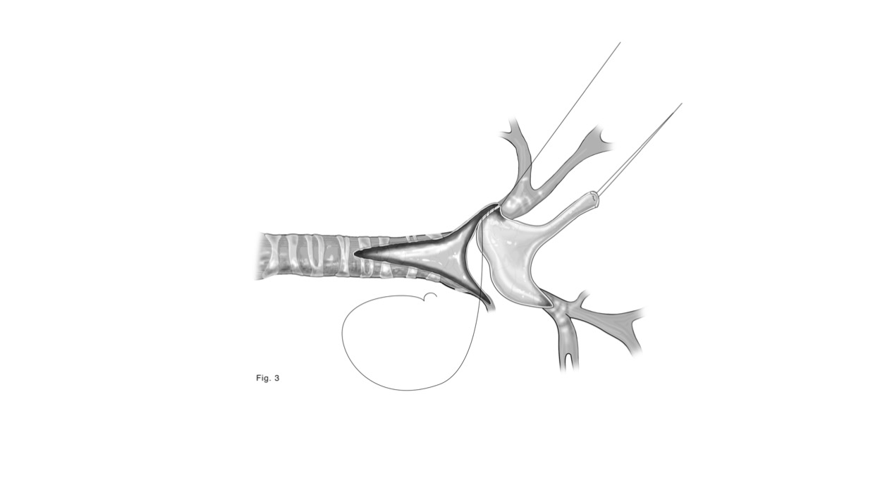 Step 2 of tracheal unifocalization, a procedure to bring the anterior and posterior tracheas together.