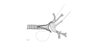 Step 2 of tracheal unifocalization, a procedure to bring the anterior and posterior tracheas together.