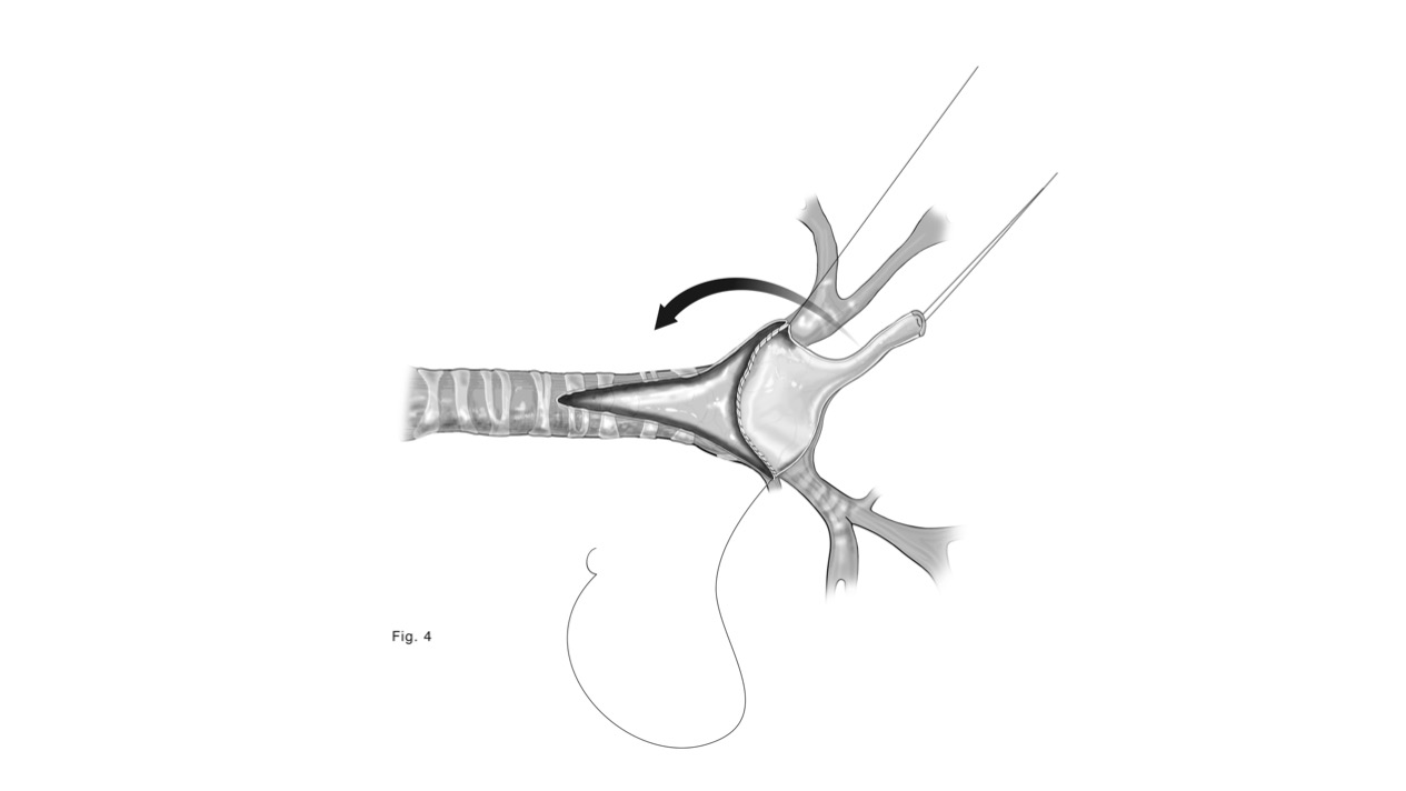 Step 3 of tracheal unifocalization, a procedure to bring the anterior and posterior tracheas together.