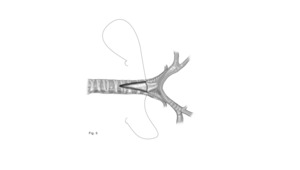 Step 4 of tracheal unifocalization, a procedure to bring the anterior and posterior tracheas together.