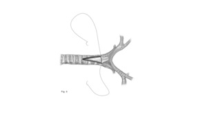 Step 4 of tracheal unifocalization, a procedure to bring the anterior and posterior tracheas together.