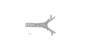 Step 5 of tracheal unifocalization, a procedure to bring the anterior and posterior tracheas together.