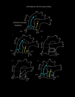 Anomalous Left Coronary Artery illustration