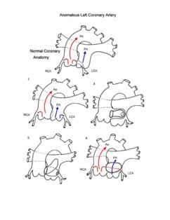 Anomalous Left Coronary Artery illustration