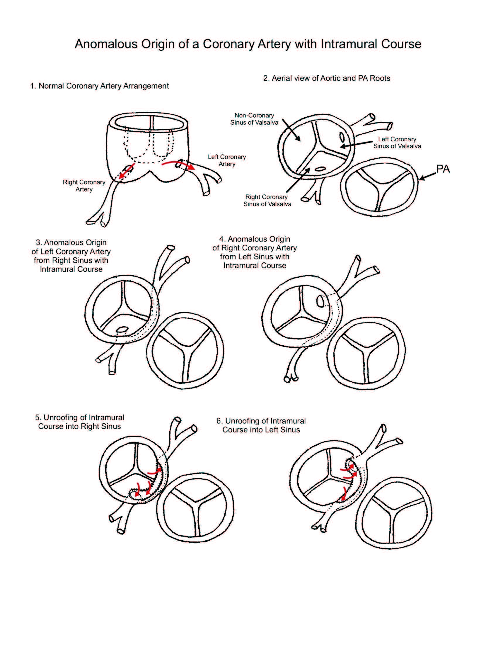 Anomalous Origin of a Coronary Artery with Intramural Course illustration