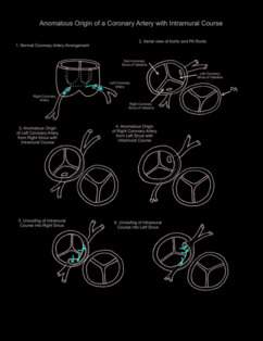 Anomalous Origin of a Coronary Artery with Intramural Course illustration