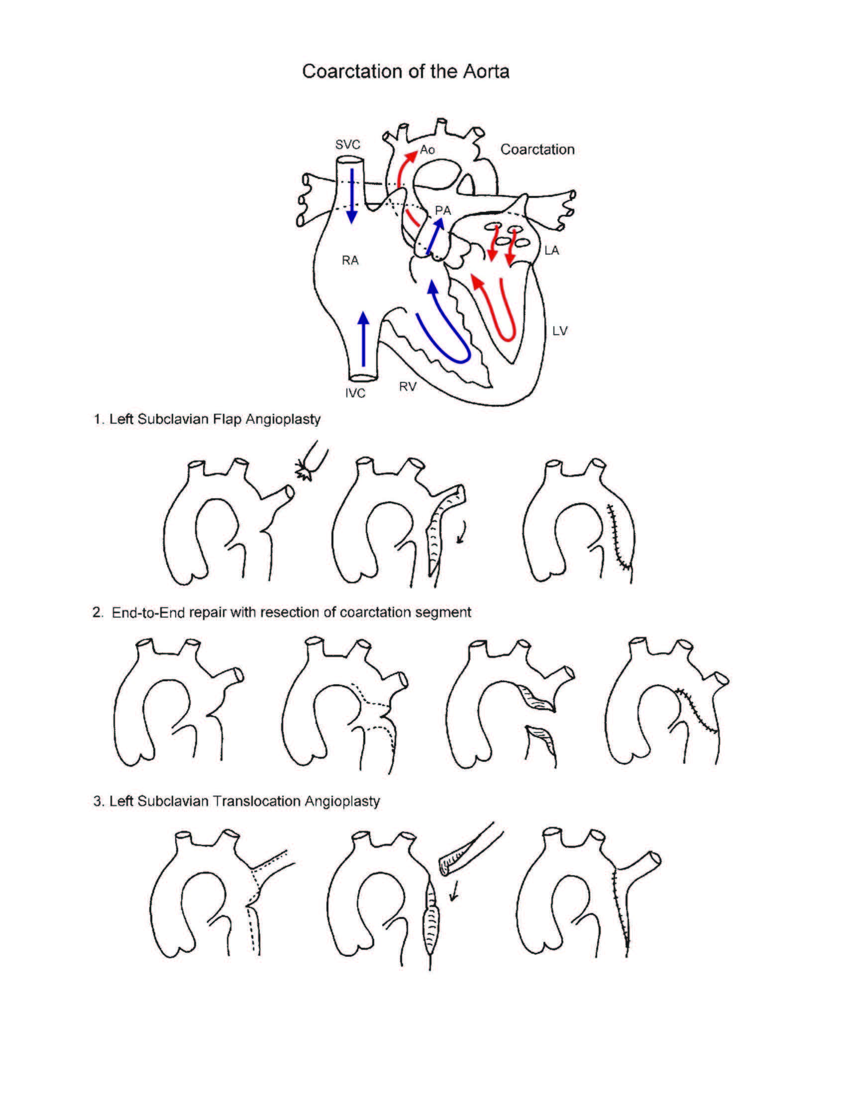 Aortic Coarctation illustration 1