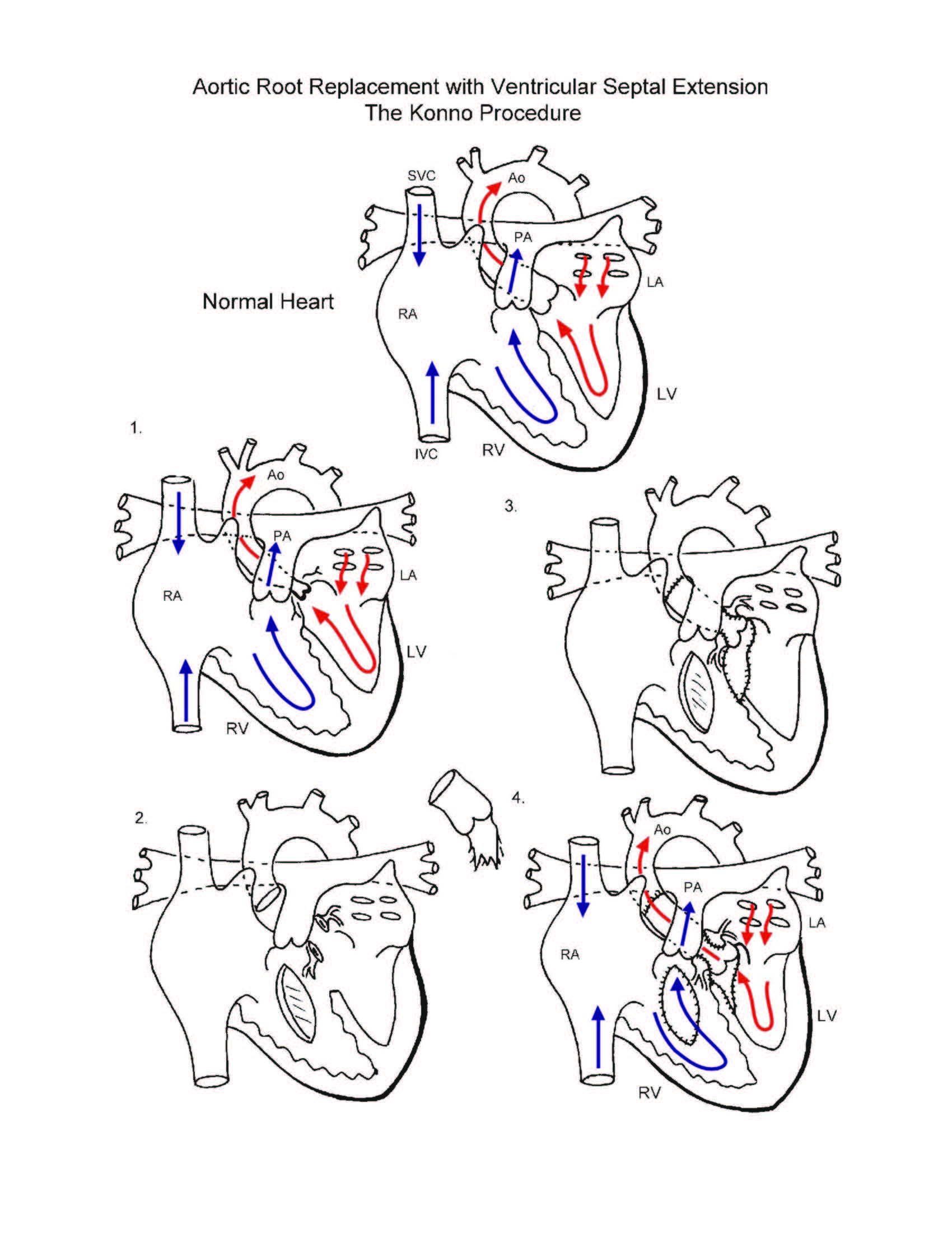 Aortic root replacement with ventricular septal defect illustration